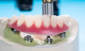 Proteza zębowa na implantach na modelu gipsowym. Dowiedz się, gdzie zrobić protezę zębową na NFZ.
