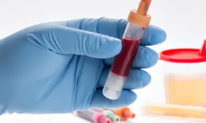 Rękawiczka w niebieskiej rękawiczce trzyma probówkę z krwią, potencjalne objawy po cystoskopii. W tle pojemnik na mocz.