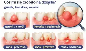 Ilustracja pokazuje różne stadia problemów z dziąsłami: guzek, krostkę, ropę i przetokę, aż do niegojących się ran w jamie ustnej.