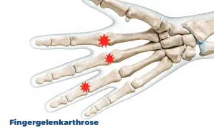 Illustration der Knochen der Hand, die Schmerzen durch Arthrose in den Fingergelenken zeigt.