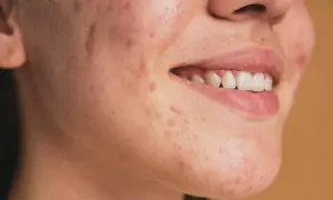 Primo piano del viso di una persona con pelle a tendenza acneica, mostrando comedoni e rossori.