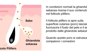 Diagramma della pelle che mostra un follicolo pilifero e una ghiandola sebacea. Punti neri giganti indicano l'accumulo di sebo.