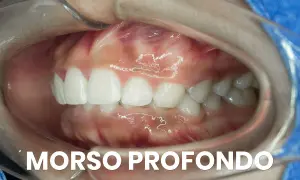 Primo piano della bocca con morso profondo, evidenziato per chirurgia maxillo-facciale.