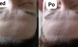 Przed i po zabiegu: zoga face wygładzona, zmarszczki na czole mniej widoczne.