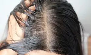 Primer plano del cuero cabelludo de una mujer con pelo graso, mostrando la separación del cabello y el brillo aceitoso.