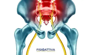 Dolore al nervo sciatico che causa scosse gamba sinistra. Anatomia del bacino e nervi evidenziati in rosso.