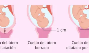 Ilustración muestra la dilatación del cuello uterino durante el parto: sin dilatación, borrado y dilatado por completo (10 cm).