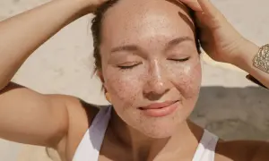 Donna con lentiggini al sole, con le mani tra i capelli. Forse la crema solare tutti i giorni fa male?