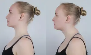 Dwie fotografie profilowe kobiety: po lewej z prostą postawą, po prawej z widocznym **wdowim garbem** i zaokrąglonymi plecami.