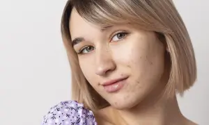 Primo piano di una giovane donna con brufoli da stress sul viso. Impara a riconoscerli e a gestirli.