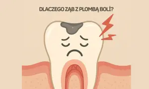 Smutny ząb z próchnicą i bólem, być może przez za wysoka plomba. Czerwone błyskawice symbolizują ból.