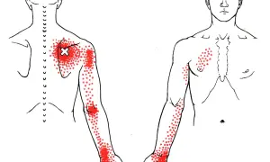 Dolor serrato posterior superior: Alivio y prevención efectiva