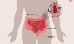 Ilustracja przedstawia jelito grube, cienkie i odbytnicę. Powiększony fragment pokazuje krew w stolcu, sugerując krwawienie z odbytu.