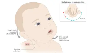 Baby mit angeborenem Schiefhals (torticollis spasticus). Kopf zur betroffenen SCM geneigt, Kinn weggedreht. Eingeschränkte Beweglichkeit.