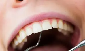 Usta z widocznym małym ubytkiem w zębie, badane narzędziem dentystycznym.
