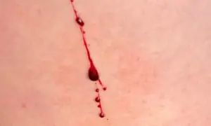 Rote Kratzer auf der Haut ohne Grund, mit Blutstropfen, die langsam herunterlaufen.
