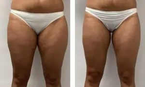 Endermologia: Kiedy efekty? Po 3 sesjach już widać! Pełna przemiana