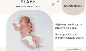 Noworodek z widocznym rozejściem mięśni brzucha, zaznaczonym na brzuszku.