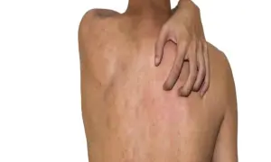 Czy kurkuma uczula? Objawy alergii i ryzyko reakcji alergicznych