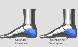 Vergleich von gesundem Fersenbein und Fersenbein mit oberem Fersensporn. Der Fersensporn ist als knöcherner Auswuchs am Fersenbein dargestellt.