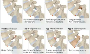 Abbildungen zeigen verschiedene Typen von Gleitwirbel LWS, von normal bis zu Frakturen und Erkrankungen.
