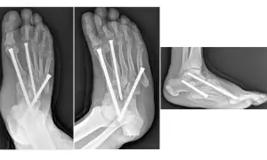 Radiografie di un piede Charcot con viti metalliche che stabilizzano le ossa fratturate.