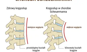 Ilustracja porównująca zdrowy kręgosłup z kręgosłupem w chorobie Scheuermanna.