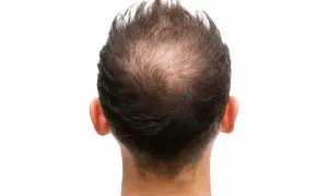 Mann mit Geheimratsecken. Informationen, wie kann man haarausfall stoppen, sind hier relevant.