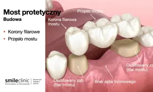 Most protetyczny z przęsłem i koronami filarowymi, uzupełniający brak 2 zębów obok siebie.