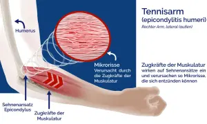 Illustration zeigt den rechten Ellenbogen bei einem Tennisarm. Zugkräfte der Muskulatur verursachen Mikrorisse am Sehnenansatz.