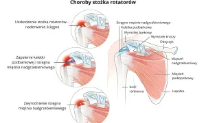 Ilustracja anatomiczna barku z zaznaczonymi uszkodzeniami stożka rotatorów: naderwanie ścięgna, zapalenie kaletki i zwyrodnienie.