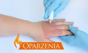 Ręka z oparzeniem, na którą nakładany jest preparat. Dowiedz się, jak zrobić opatrunek na oparzenia.