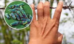 Dłoń dotykająca drutu kolczastego, obok powiększenie bakterii Clostridium tetani. Wczesne tężec objawy mogą być subtelne, ale choroba jest groźna.