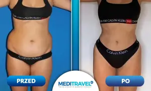 Przed i po liposukcji laserowej. Zobacz, jak zmieniła się sylwetka. Sprawdź, jaka jest liposukcja laserowa cena i zacznij swoją metamorfozę!