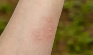 Na skórze widoczne są bąble pokrzywkowe. Czy pokrzywka jest niebezpieczna? Zwykle nie, ale warto obserwować objawy.