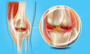 Ilustracja anatomiczna kolana z zaznaczonym bólem łąkotki i jej uszkodzeniem.