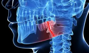 Złamana żuchwa po uderzeniu, zaznaczona na czerwono. Widok anatomiczny szczęki i kręgosłupa szyjnego.