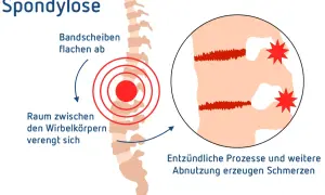 Spondylose LWS: Bandscheiben flachen ab, Raum zwischen Wirbelkörpern verengt sich. Entzündliche Prozesse und Abnutzung erzeugen Schmerzen.