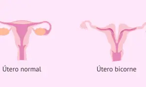 Comparación visual de un útero normal y un útero bicorne, mostrando la forma dividida de este último.