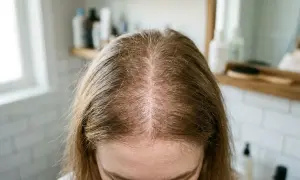 Vue du dessus du cuir chevelu clairsemé d'une femme, espérant retrouver une masse capillaire naturellement.