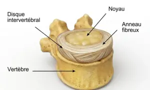 Disque intervertébral, noyau et anneau fibreux, montrant la structure d'une vertèbre, essentielle pour comprendre une hernie discale.