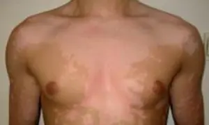 Skóra klatki piersiowej z widocznymi jasnymi plamami, które mogą być objawem vitiligo. Co to jest vitiligo? To choroba autoimmunologiczna.