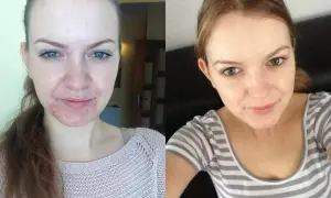 Przed i po kuracji izotekiem. Po lewej widoczne skutki uboczne leczenia trądziku: zaczerwienienia i wypryski. Po prawej gładka, czysta skóra.