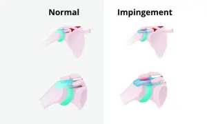 Schultergelenk: Normal vs. Impingement. Die obere Reihe zeigt eine gesunde Schulter, die untere zeigt das Impingement-Syndrom, das Schmerzen bei bestimmten Schlafpositionen verursachen kann.