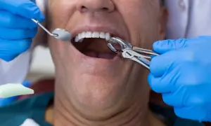 Dentysta w niebieskich rękawiczkach używa kleszczy do ekstrakcji zęba. Pacjent ma otwarte usta, widać jego zęby.