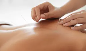 Main d'acupuncteur plaçant des aiguilles sur le dos d'une personne. L'acupuncture effet au bout de combien de temps ?