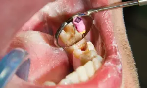 Dentysta używa lusterka, by zobaczyć, jak wygląda ropa w zębie. Widać narzędzie stomatologiczne i fragment zęba.