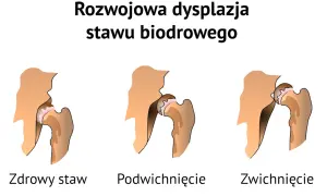 Poduszka Frejki: Jak długo? Decyzja ortopedy i Twoja rola