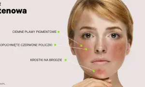 Twarz młodej kobiety z zaczerwienionymi policzkami, ciemnymi plamami i krostkami na brodzie. Objawy celiakii i nietolerancji glutenu.
