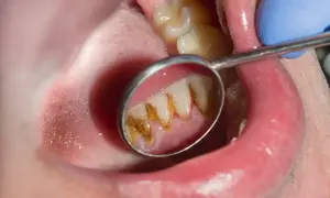 Widok zęba w lusterku dentystycznym, gdzie kamień nazębny sam odpada, odsłaniając zdrowszą powierzchnię.